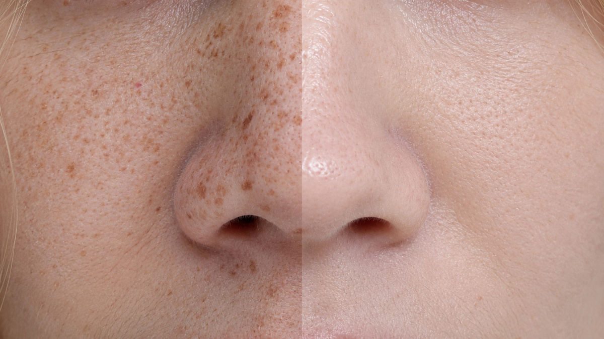 Crema Anti Macchia Viso: Come Funziona e Come Sceglierla nel 2026